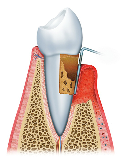 Stages of Gum Disease Elizabethtowne, KY