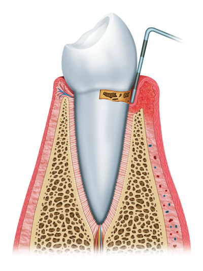 Stages of Gum Disease Elizabethtowne, KY