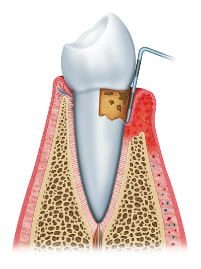 Stages of Gum Disease Elizabethtowne, KY