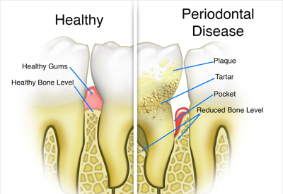Gum Disease and Tooth and Bone Loss Elizabethtowne, KY